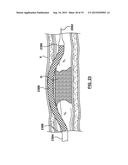 Catheter Assemblies and Methods for Stabilizing a Catheter Assembly Within     a Subintimal Space diagram and image