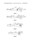 MECHANICAL DILATION OF THE OSTIA OF PARANASAL SINUSES AND OTHER     PASSAGEWAYS OF THE EAR, NOSE AND THROAT diagram and image