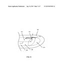 METHODS AND APPARATUS RELATED TO A SIDE-FIRE OPTICAL FIBER HAVING A ROBUST     DISTAL END PORTION diagram and image