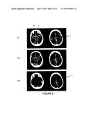 SYSTEMS AND METHODS FOR DIAGNOSING STROKES diagram and image