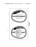 SYSTEMS AND METHODS FOR DIAGNOSING STROKES diagram and image