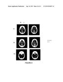 SYSTEMS AND METHODS FOR DIAGNOSING STROKES diagram and image