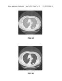 SYSTEM AND METHOD FOR AUTOMATED DETECTION OF LUNG NODULES IN MEDICAL     IMAGES diagram and image