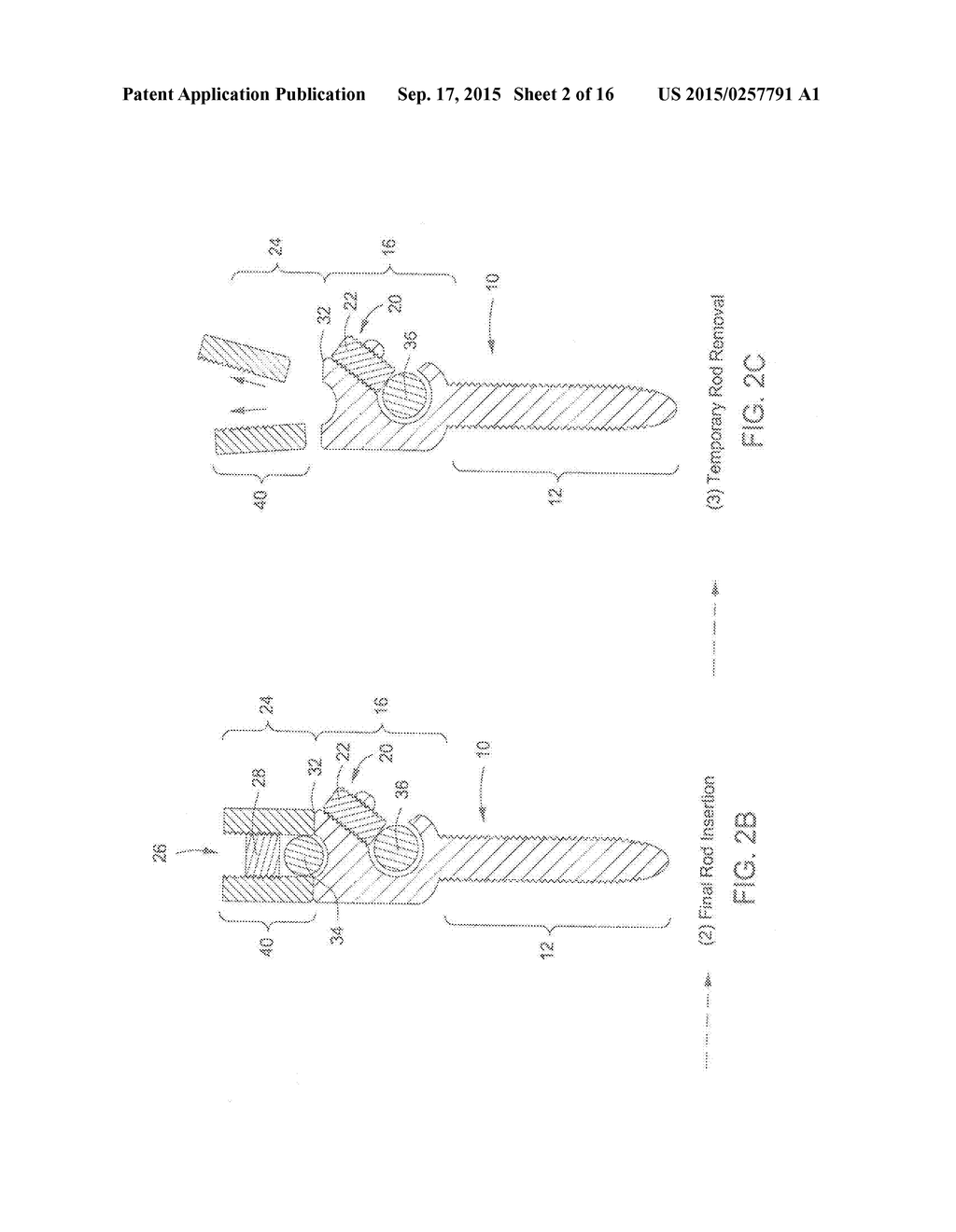 Pedicle Screw - diagram, schematic, and image 03