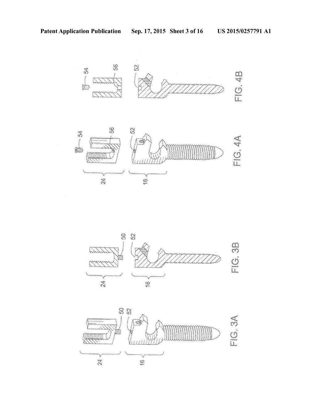 Pedicle Screw - diagram, schematic, and image 04