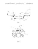 SPINAL IMPLANT SYSTEM AND METHODS OF USE diagram and image