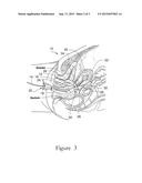 ELECTROSURGICAL ELEMENT AND UTERINE MANIPULATOR FOR TOTAL LAPAROSCOPIC     HYSTERECTOMY diagram and image