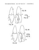 Dental Composite Dispenser For Injection Molded Filling Techniques diagram and image