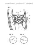 TRANSCATHETER VALVE PROSTHESIS diagram and image