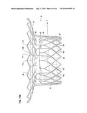 TRANSCATHETER VALVE PROSTHESIS diagram and image