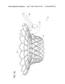 TRANSCATHETER VALVE PROSTHESIS diagram and image