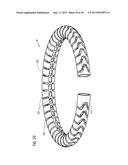 TRANSCATHETER VALVE PROSTHESIS diagram and image