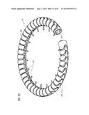 TRANSCATHETER VALVE PROSTHESIS diagram and image