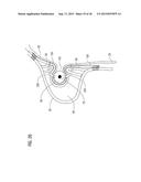 TRANSCATHETER VALVE PROSTHESIS diagram and image