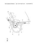 TRANSCATHETER VALVE PROSTHESIS diagram and image