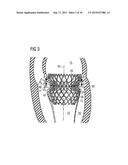 TRANSCATHETER VALVE PROSTHESIS diagram and image