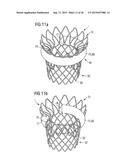 TRANSCATHETER VALVE PROSTHESIS diagram and image