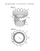 TRANSCATHETER VALVE PROSTHESIS diagram and image