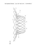 TRANSCATHETER VALVE PROSTHESIS diagram and image