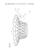 TRANSCATHETER VALVE PROSTHESIS diagram and image