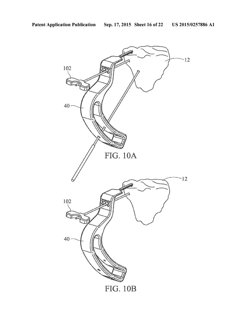 METHOD FOR TREATING JOINT PAIN AND ASSOCIATED INSTRUMENTS - diagram, schematic, and image 17