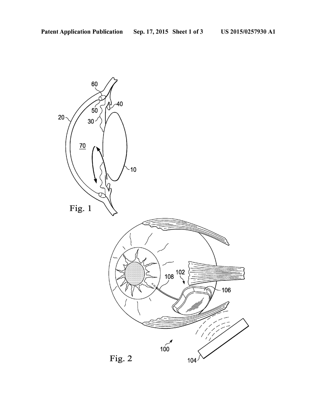 Debris Clearance System for an Ocular Implant - diagram, schematic, and image 02