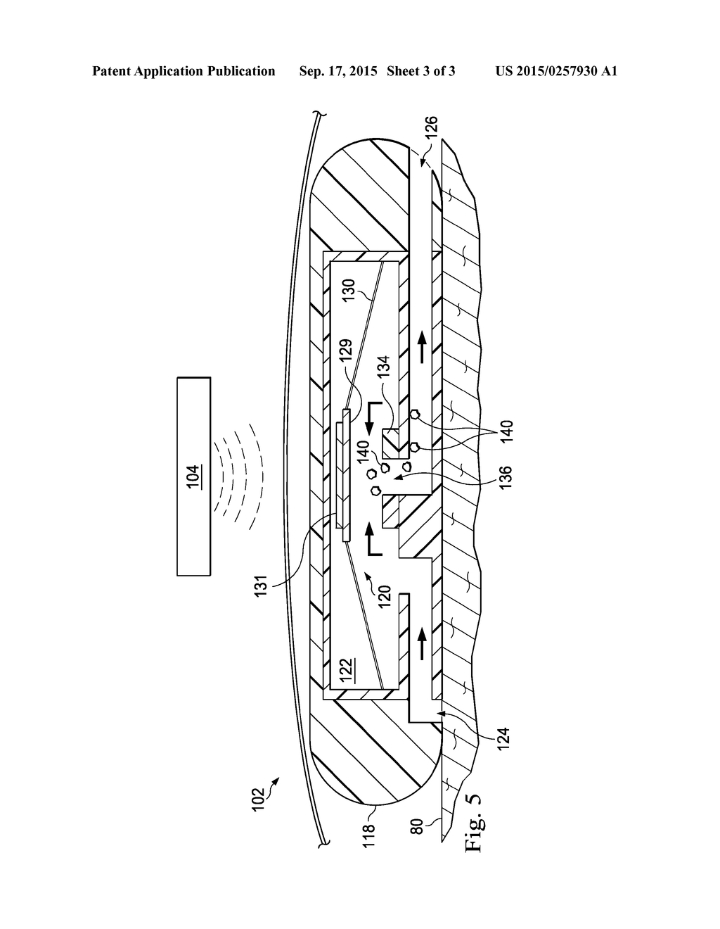 Debris Clearance System for an Ocular Implant - diagram, schematic, and image 04