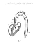 CATHETER DEVICE diagram and image