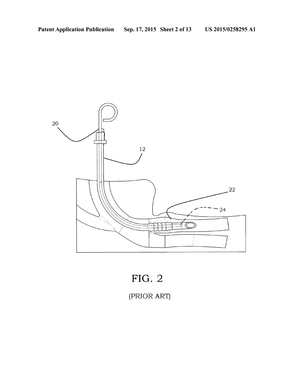 DEVICE FOR INTRODUCING AN AIRWAY TUBE INTO THE TRACHEA - diagram, schematic, and image 03