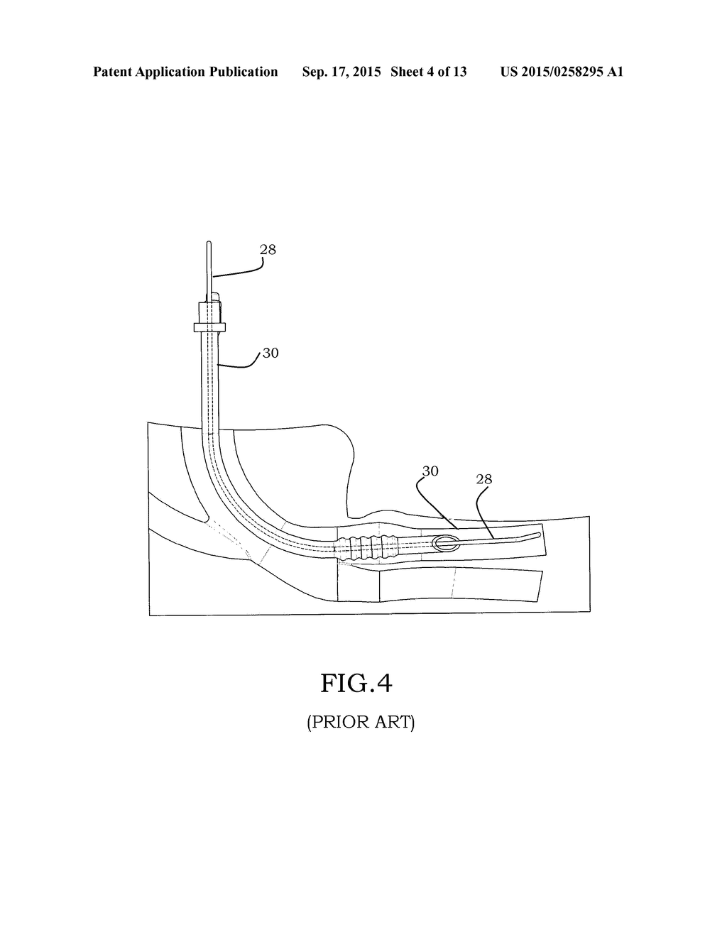 DEVICE FOR INTRODUCING AN AIRWAY TUBE INTO THE TRACHEA - diagram, schematic, and image 05