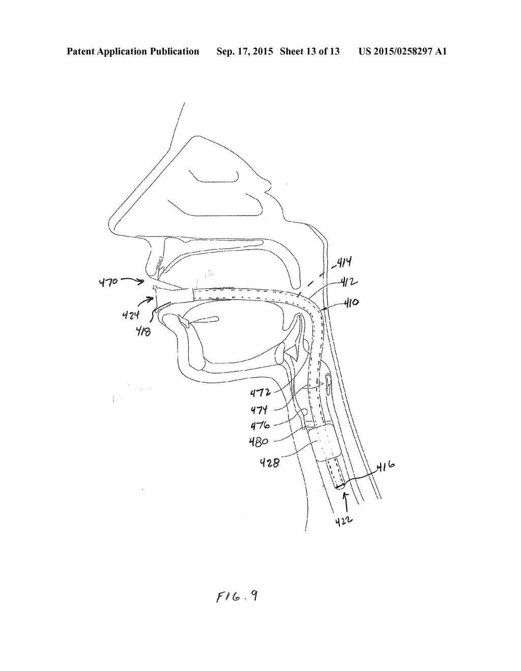 ENDOTRACHEAL TUBE HAVING OUTER AND INNER CANNULAE - diagram, schematic, and image 14