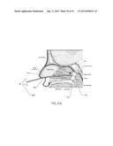 METHOD OF PERFORMING A SPHENOPALATINE GANGLION BLOCK PROCEDURE diagram and image