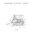 METHOD OF PERFORMING A SPHENOPALATINE GANGLION BLOCK PROCEDURE diagram and image