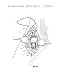 VASCULAR ACCESS PORT SYSTEMS AND METHODS diagram and image