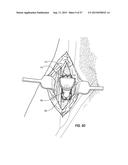 VASCULAR ACCESS PORT SYSTEMS AND METHODS diagram and image