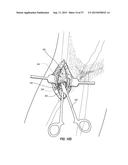 VASCULAR ACCESS PORT SYSTEMS AND METHODS diagram and image