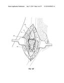 VASCULAR ACCESS PORT SYSTEMS AND METHODS diagram and image