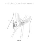 VASCULAR ACCESS PORT SYSTEMS AND METHODS diagram and image