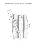 VASCULAR ACCESS PORT SYSTEMS AND METHODS diagram and image