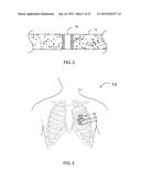 Surgical Method Utilizing a True Multiple-Fire Surgical Stapler diagram and image