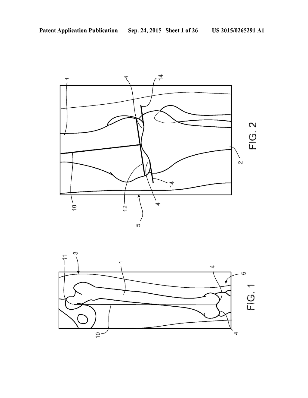 ALIGNMENT DEVICES AND METHODS - diagram, schematic, and image 02