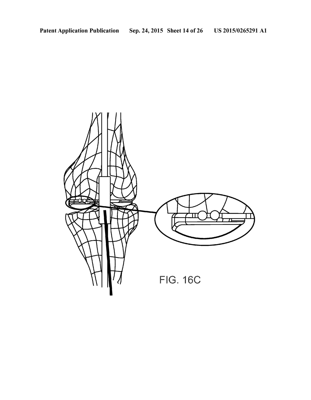 ALIGNMENT DEVICES AND METHODS - diagram, schematic, and image 15