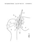 ANATOMIC FEMORAL GUIDE diagram and image