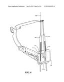 ANATOMIC FEMORAL GUIDE diagram and image