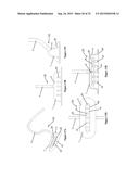 VACUUM COAGULATION PROBES diagram and image