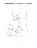 NERVE ABLATION DEVICES AND RELATED METHODS OF USE AND MANUFACTURE diagram and image