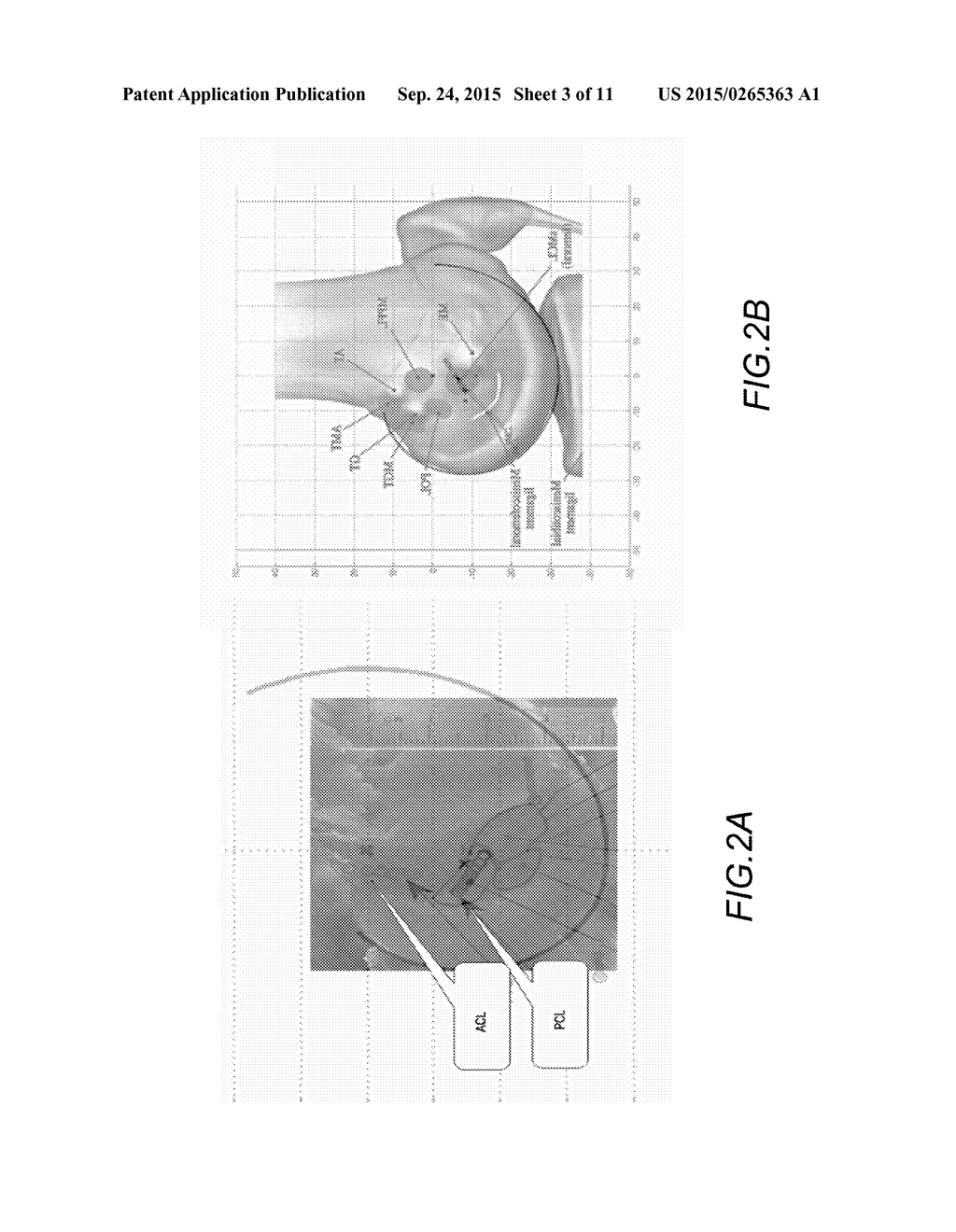 SYSTEM AND METHOD FOR LIGAMENT INSERTION IN KNEE JOINT SURGERIES USING     ADAPTIVE MIGRATION OF LIGAMENT INSERTION GEOMETRY - diagram, schematic, and image 04