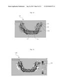 DENTAL IMPLANT INSERTION SET AND MANUFACTURING METHOD THEREOF diagram and image