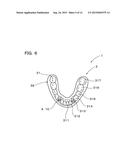 IMPLANT OVERDENTURE SYSTEM AND IMPLANT diagram and image