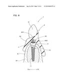 IMPLANT OVERDENTURE SYSTEM AND IMPLANT diagram and image